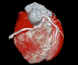 心臓CTイメージ1