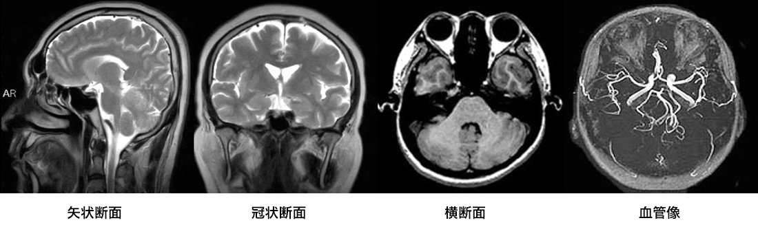 MRI画像