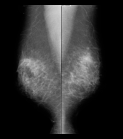 マンモグラフィ撮影画像